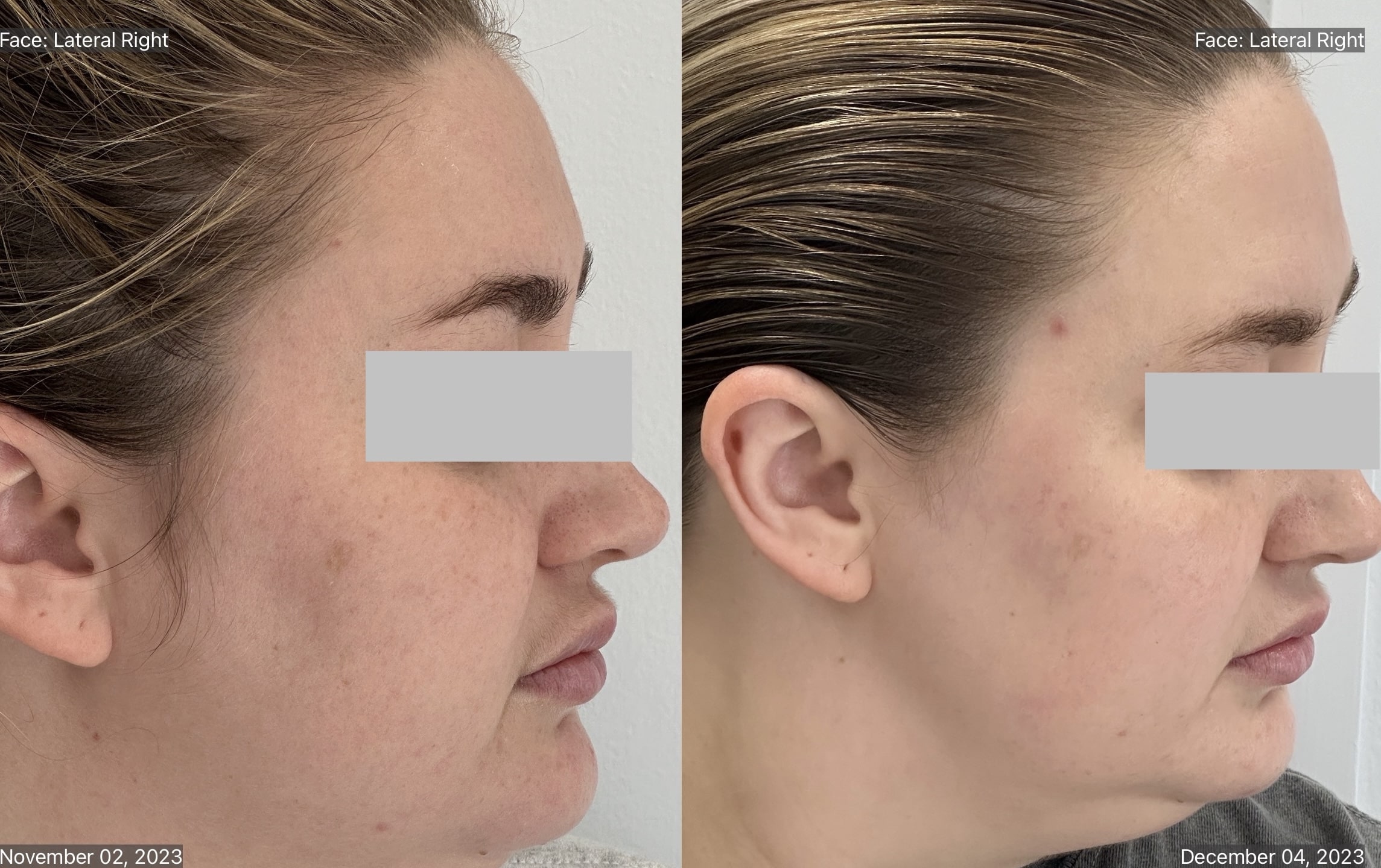 CHEMICAL PEEL-min