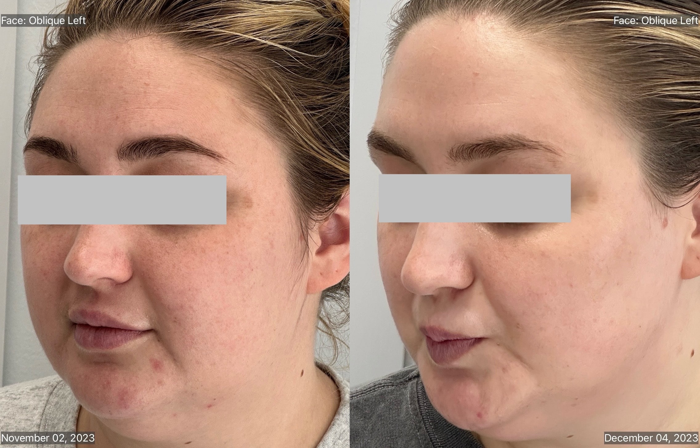 CHEMICAL PEEL.-min