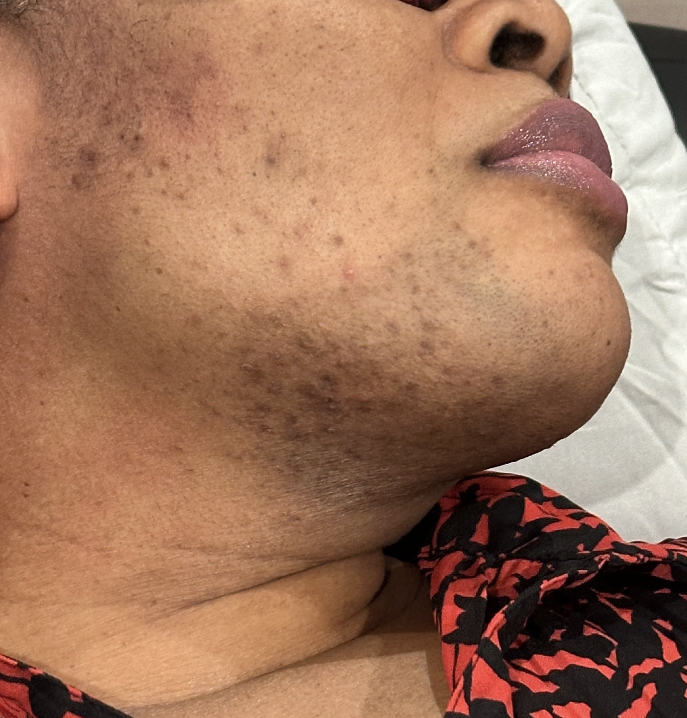 LASER HAIR REMOVAL (AFTER) (1)-min