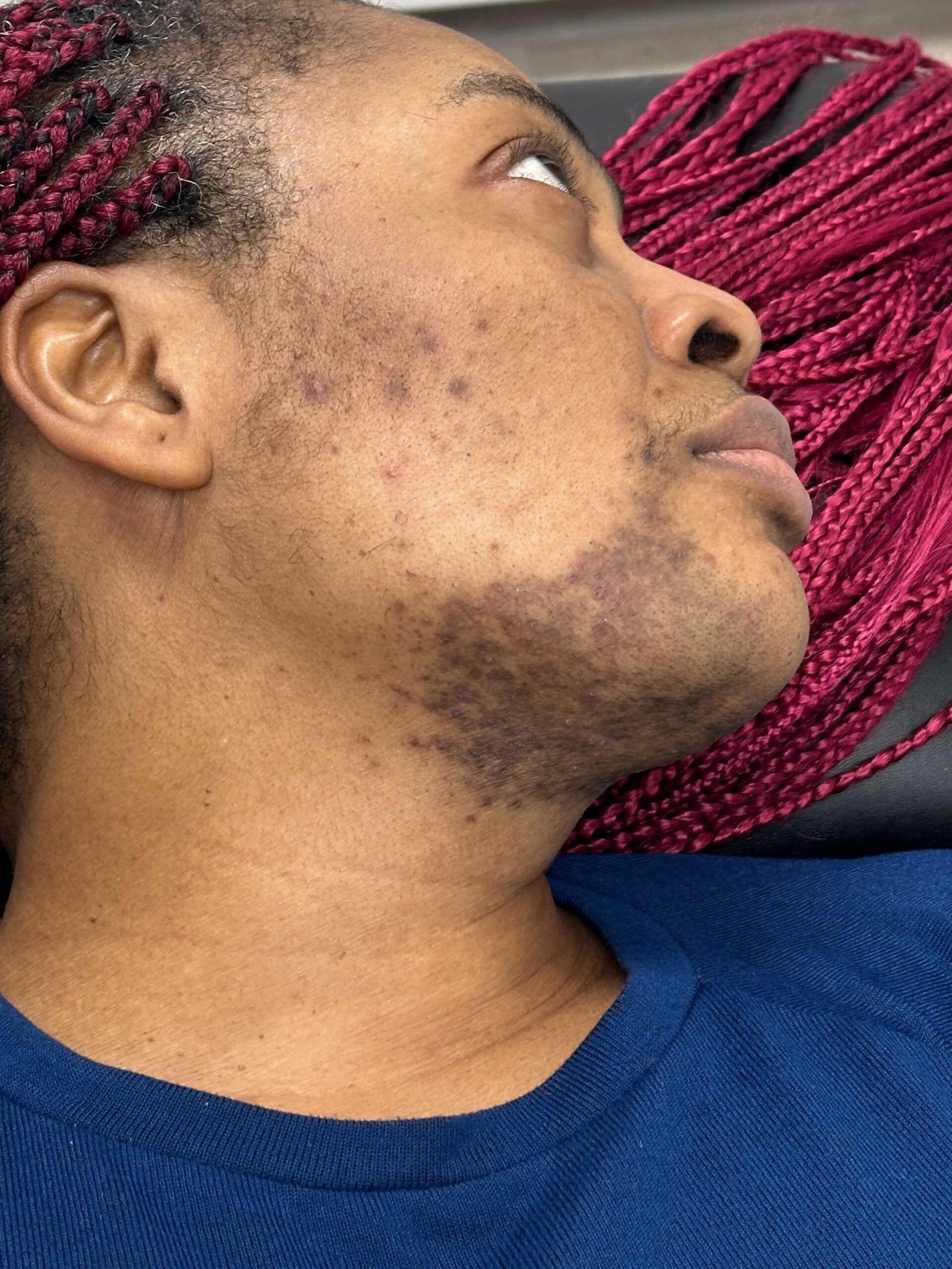 LASER HAIR REMOVAL (BEFORE)-min