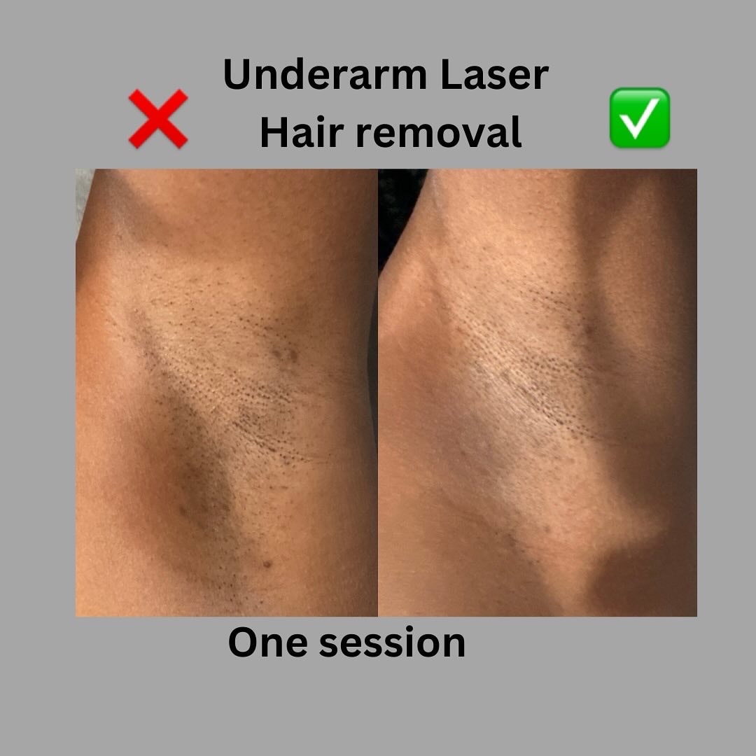 LASER HAIR REMOVAL B_A-min