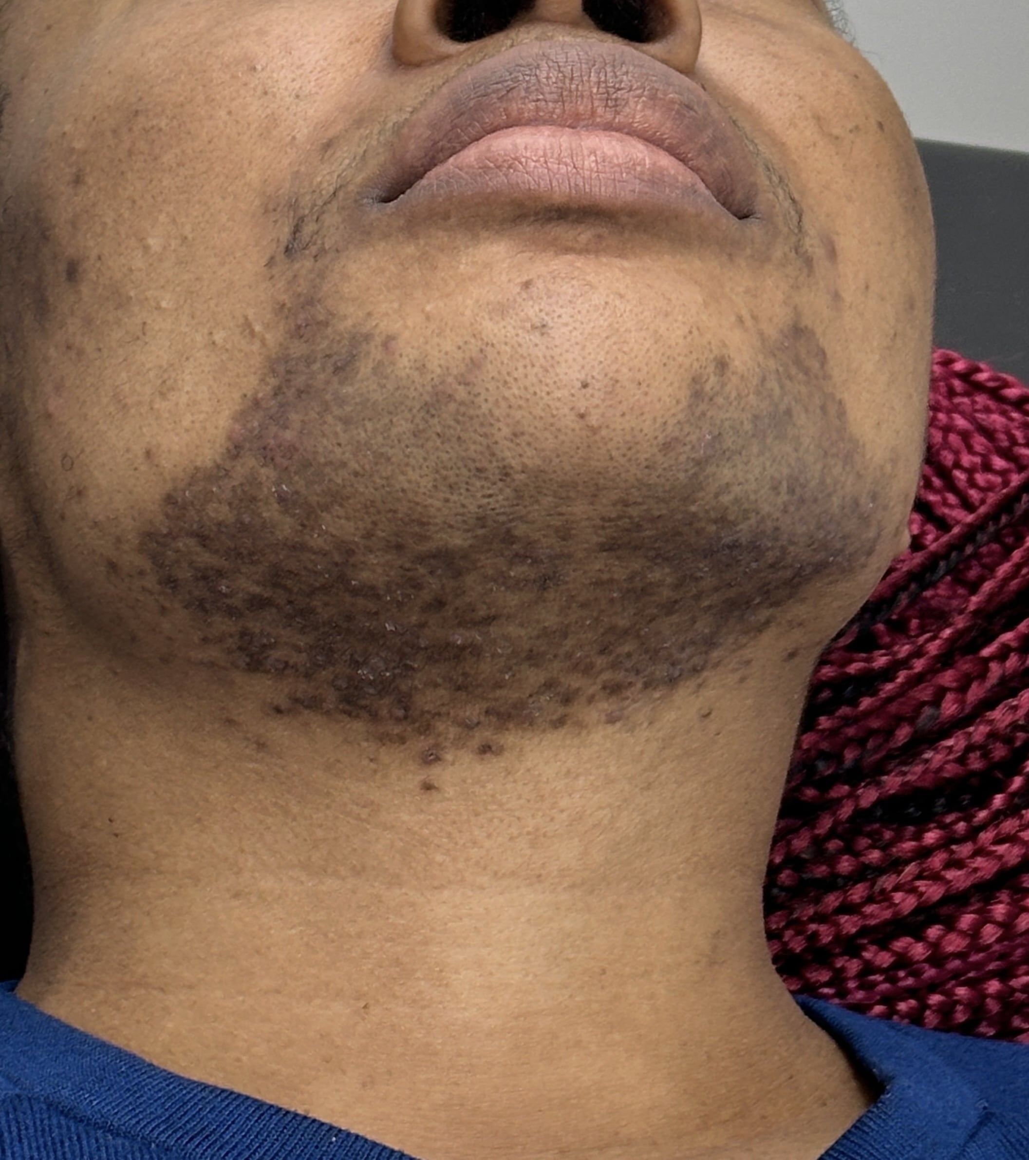 Laser hair removal ( BEFORE )-min