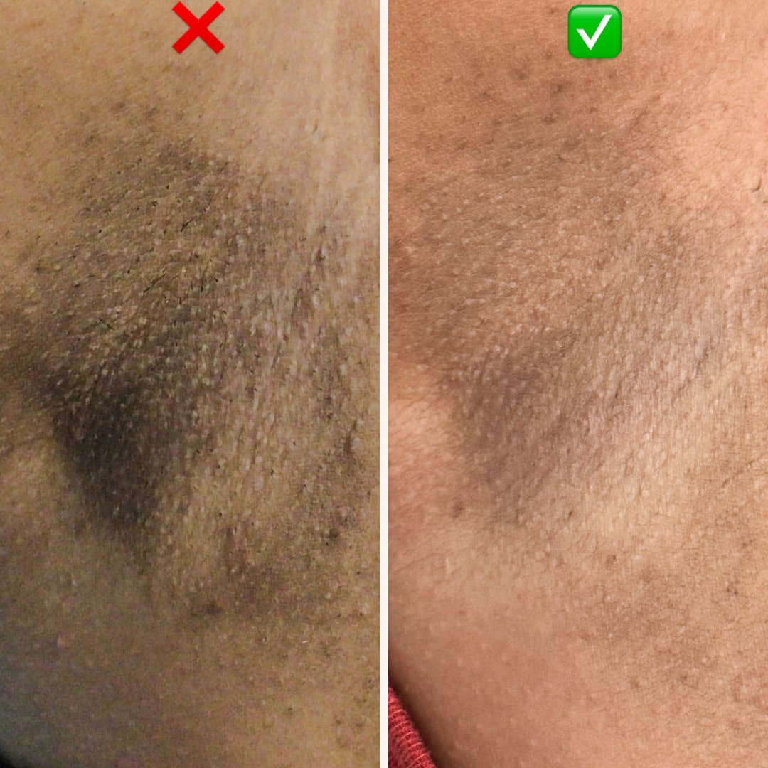 Laser hair removal B_A (1)-min