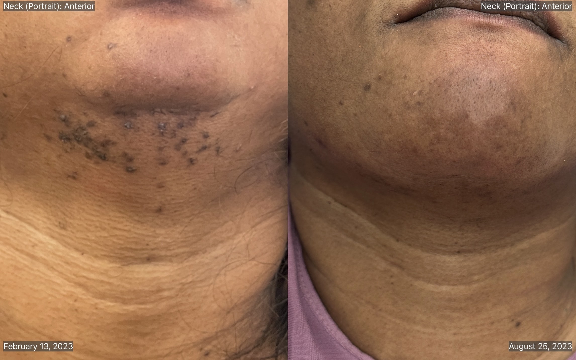 Laser hair removal B_A-min