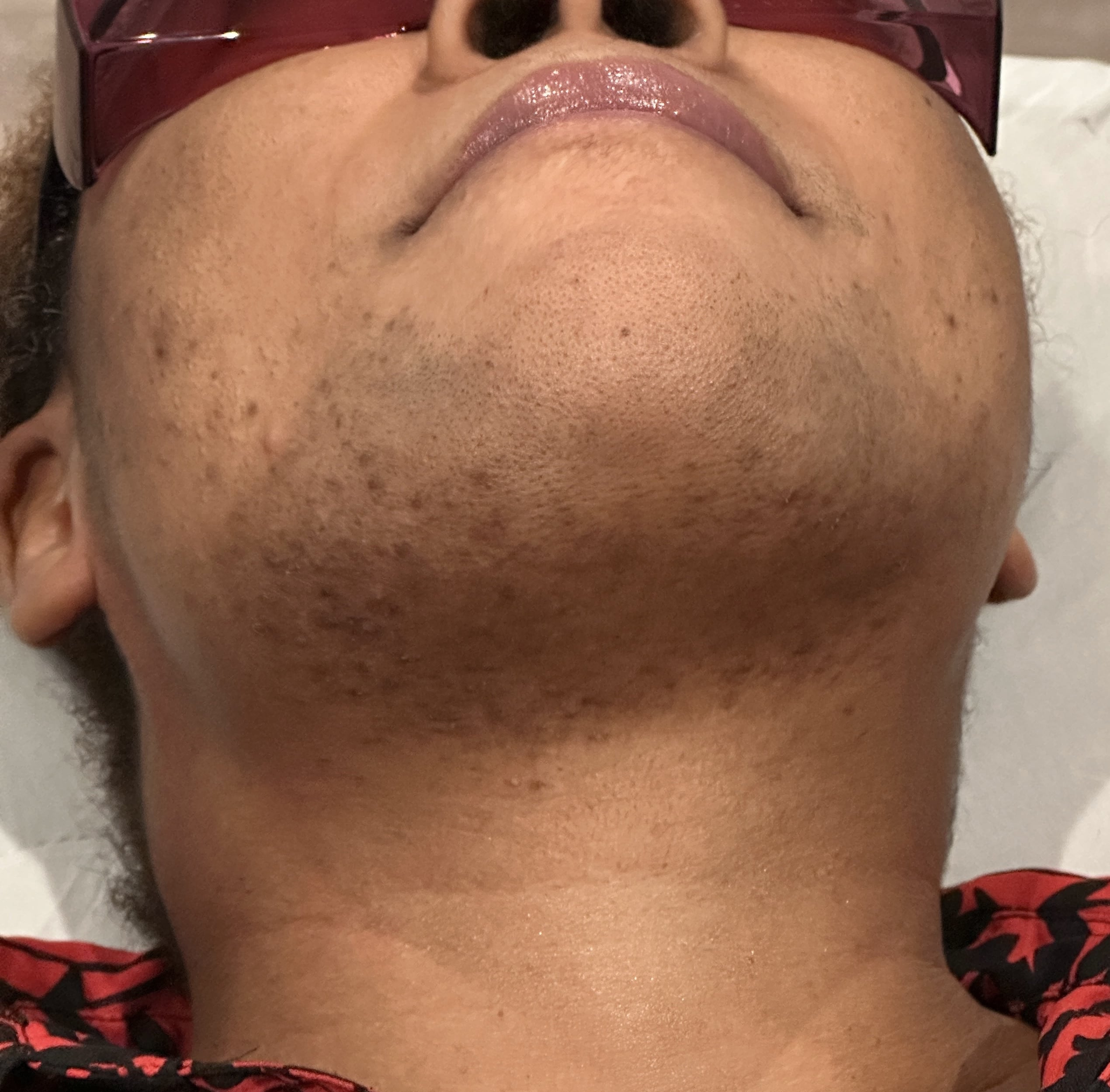 Laser hair removal (after)-min