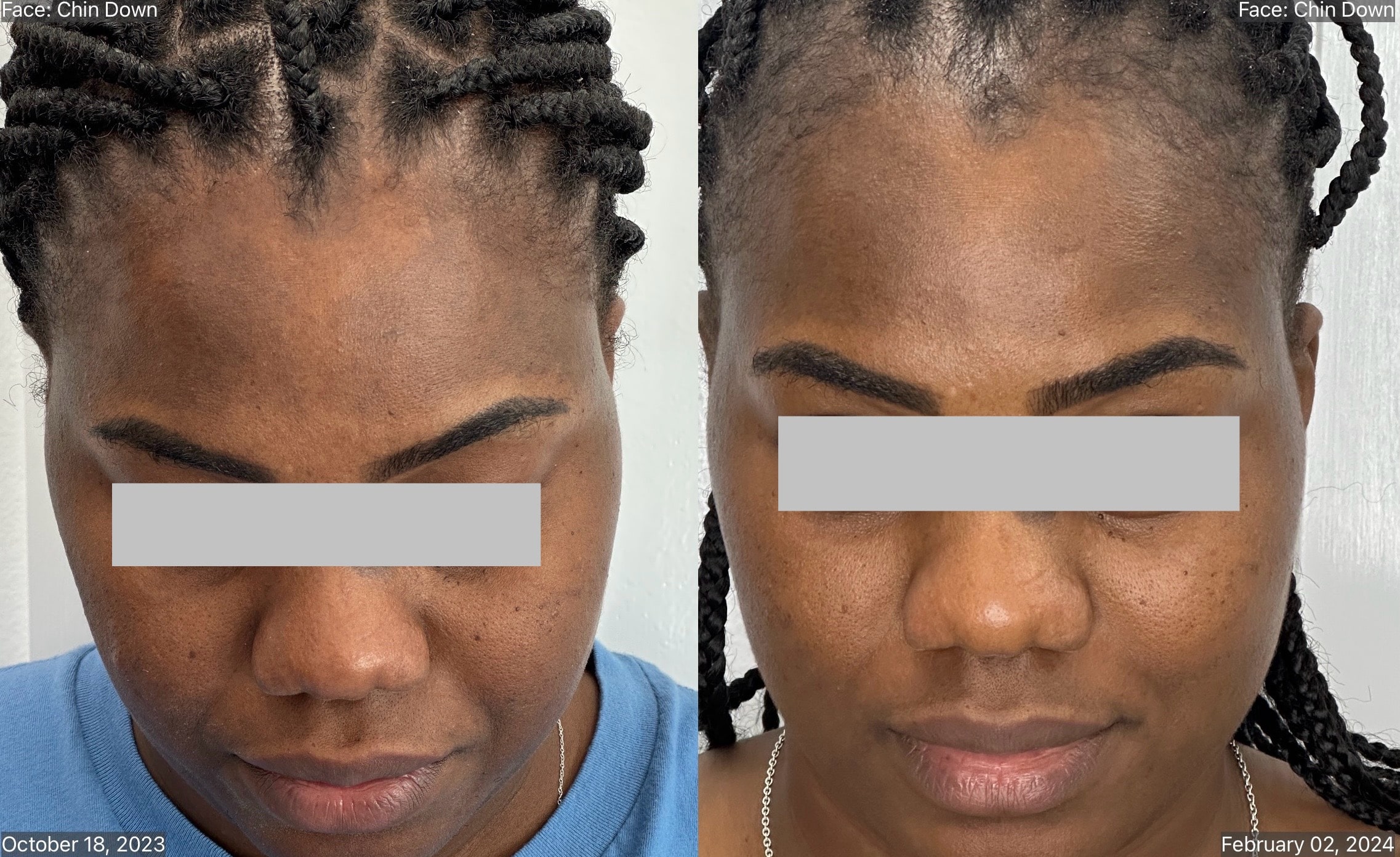 MICRODERMABRASION (2)-min