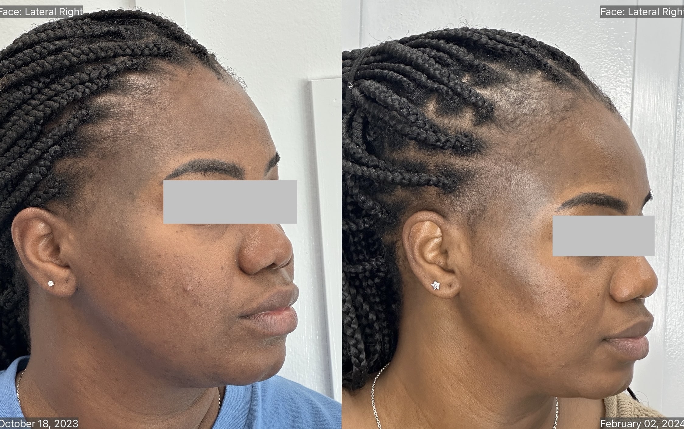 MICRODERMABRASION-min