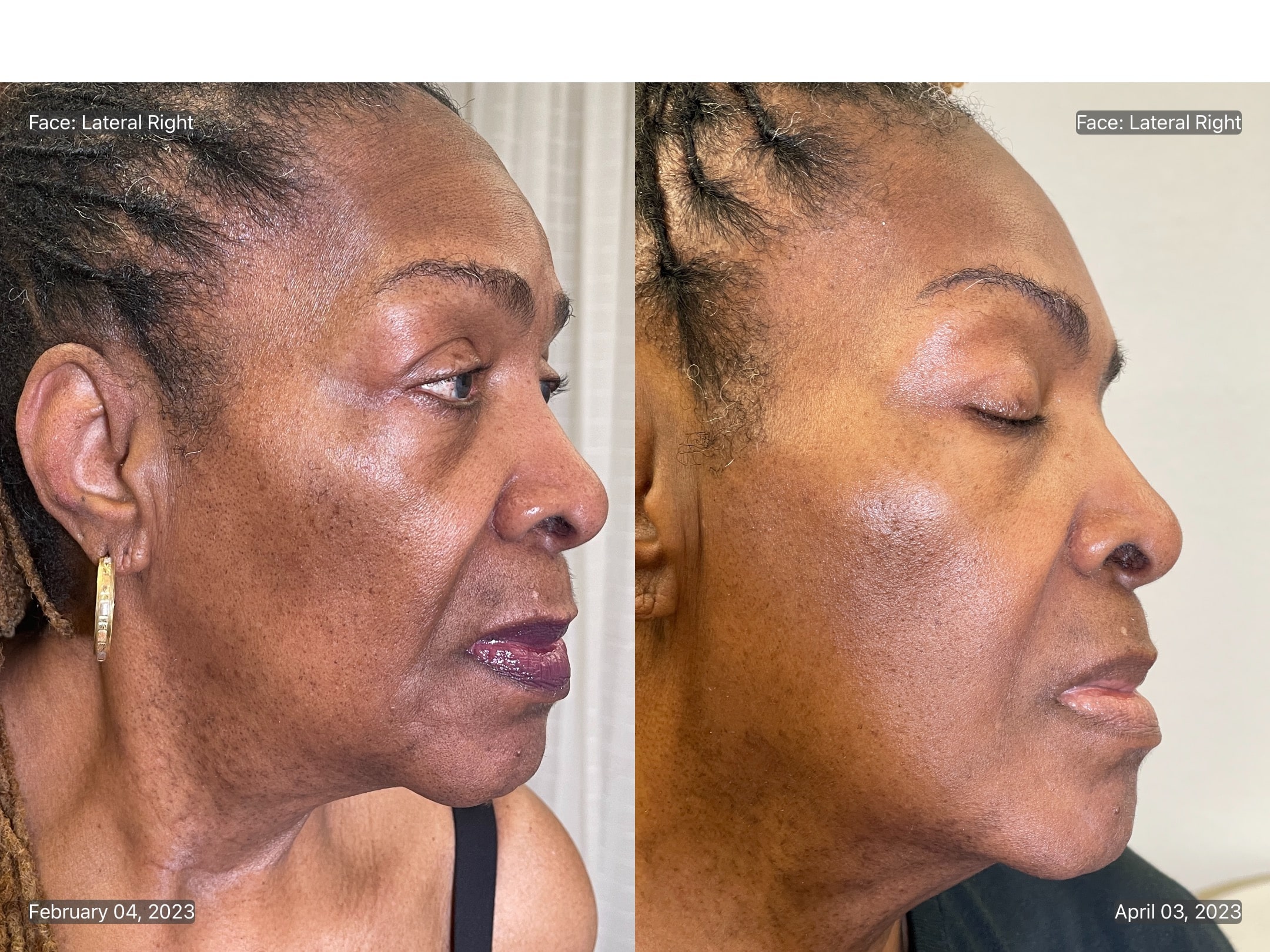 MICRONEEDLING B_A (1)-min
