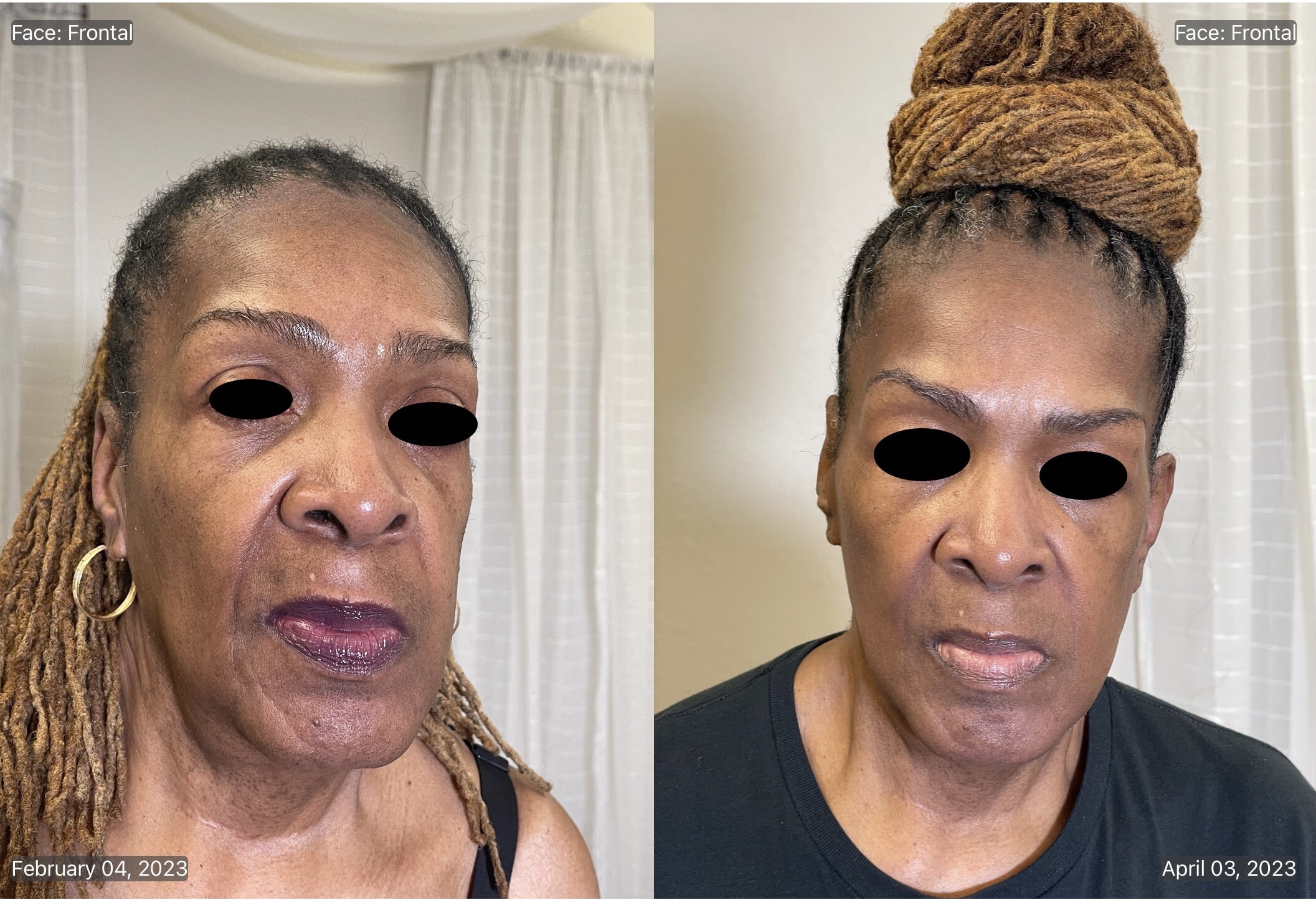 MICRONEEDLING B_A-min