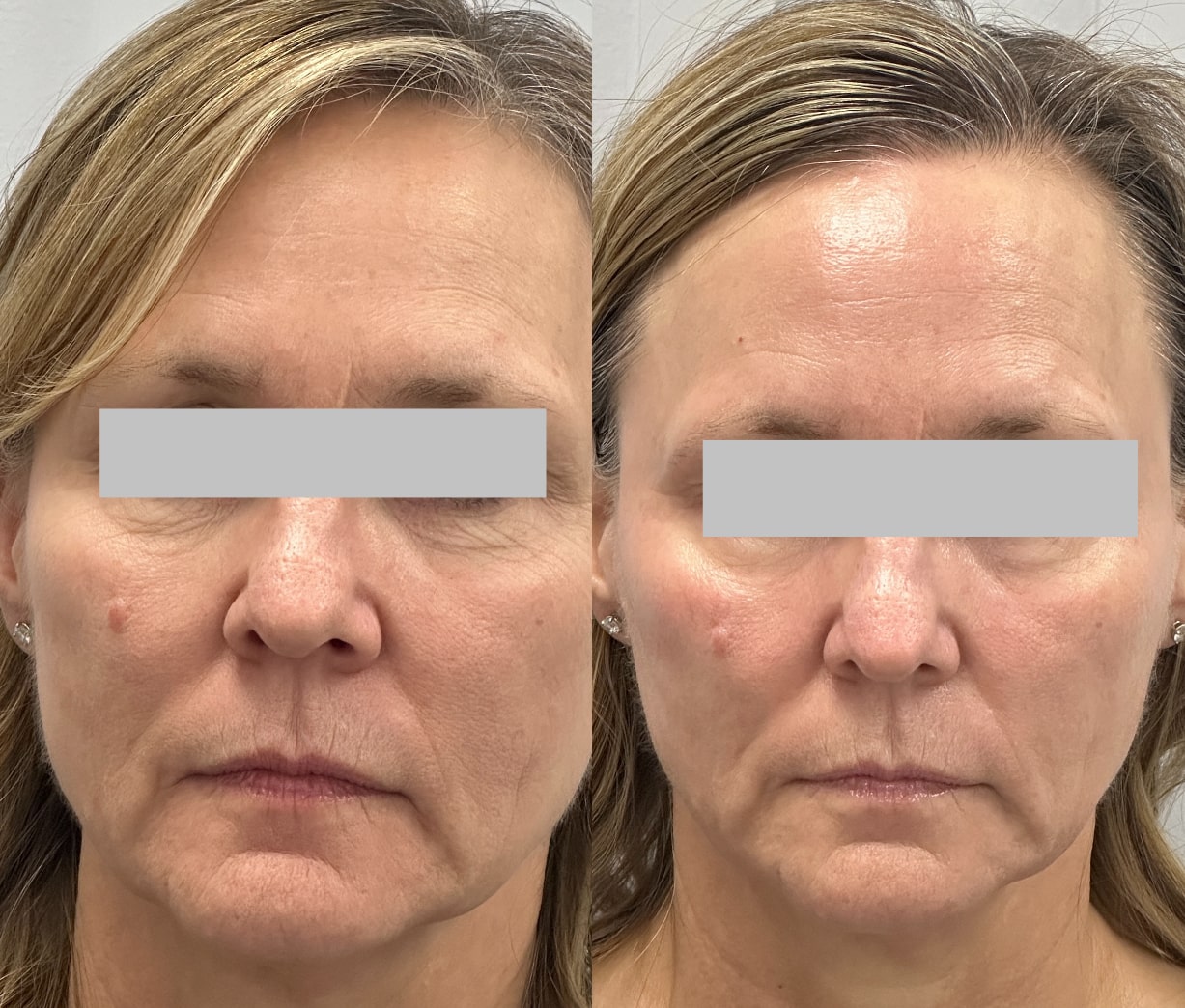 MICRONEEDLING-min