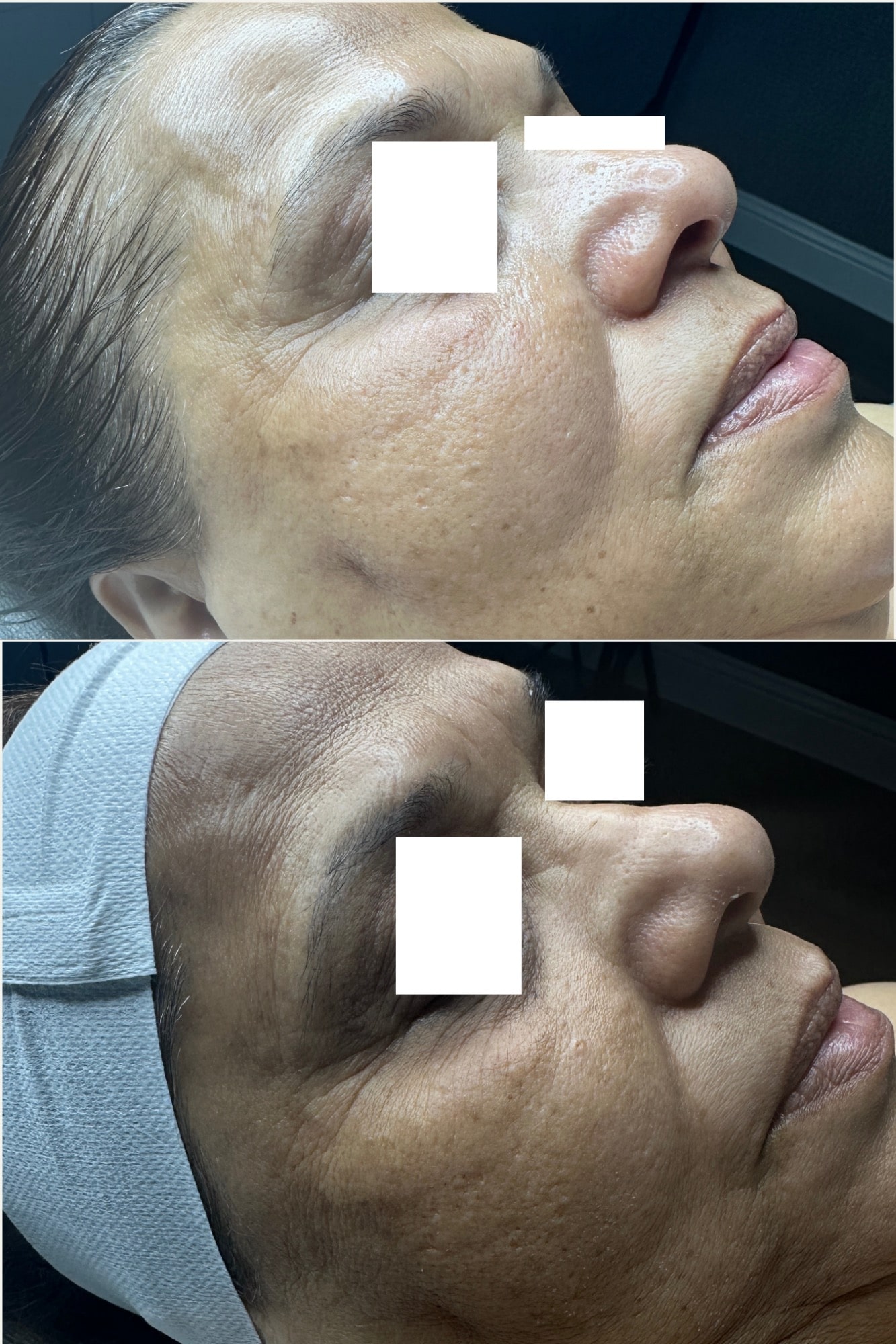 Microdermabrasion (1)-min