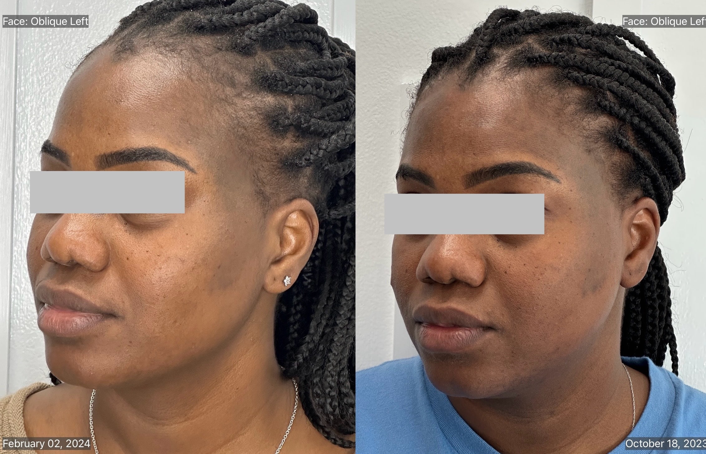 Microdermabrasion B_A-min